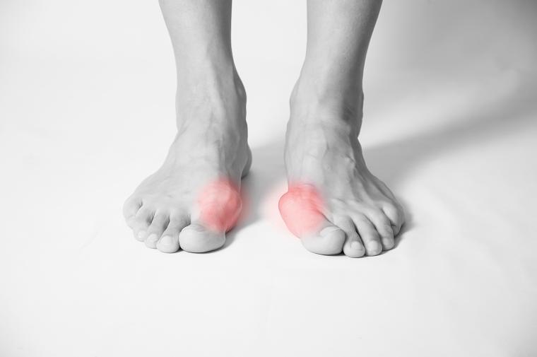 Hallux valgus pathologie et traitement GIBAUD